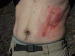 My scraped up stomach--about the best possible outcome for an uncontrolled slide down an icy slope